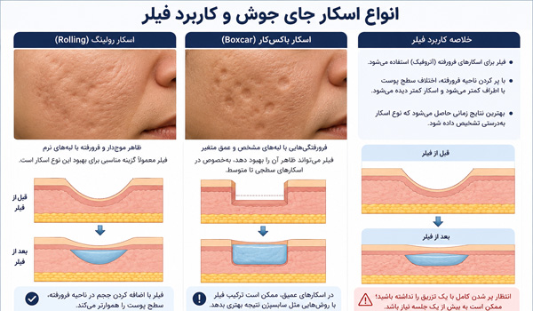 بهترین فیلر برای جای جوش کدام است؟